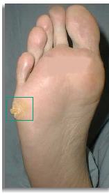Foot & Toe Corns on Feet | Dr. Scholl's®